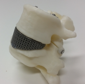 Figure of a spinal Ti lattice-based disc in a model of deformed lumbar vertebrae. The disc was manufactured at RMIT Centre for Additive Manufacturing and implanted into a patient in 2015.